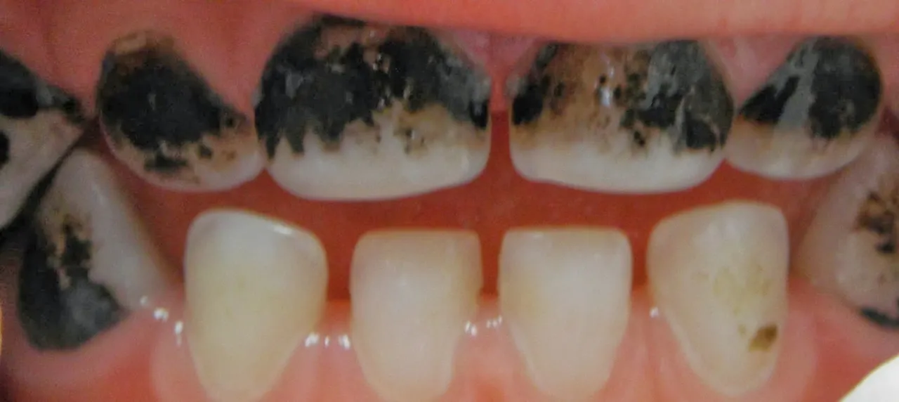 Robaki w zębach: problemy i leczenie, które mogą cię zaskoczyć