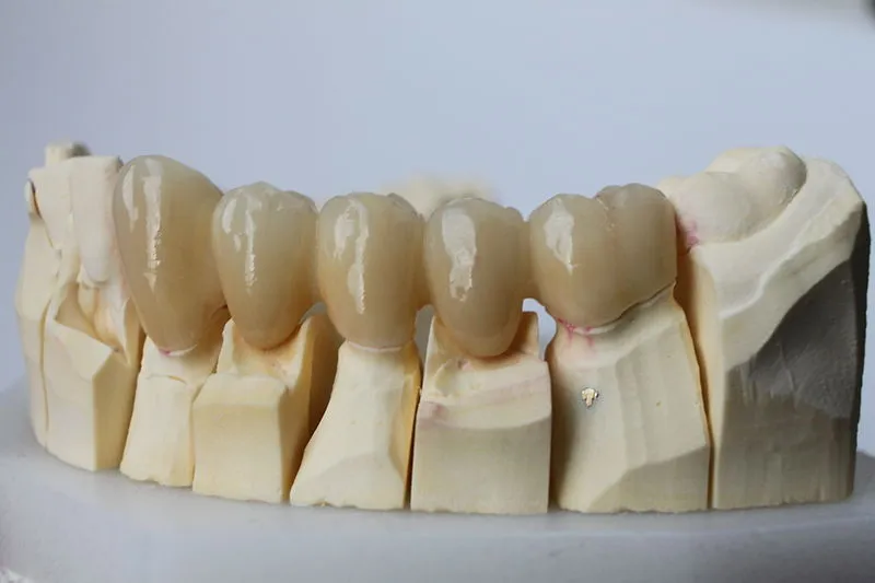 Most protetyczny: Jak wygląda? Efekty, materiały i porównanie