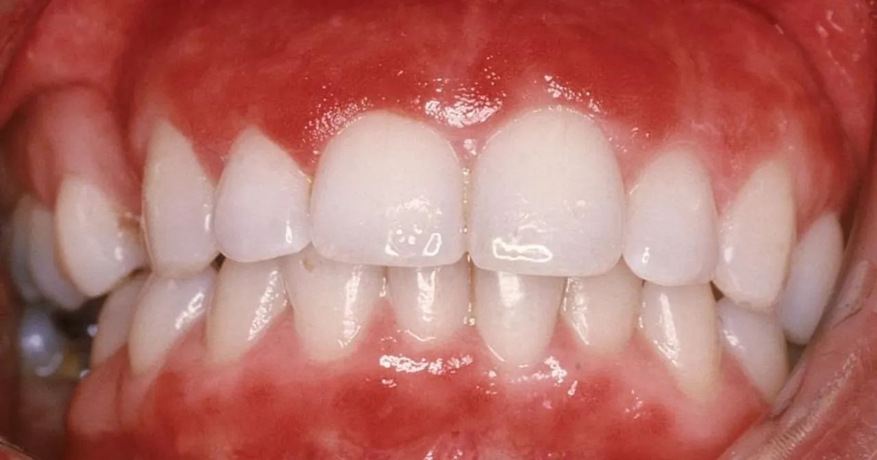 Jak wygląda zapalenie dziąseł? Objawy, które mogą cię zaskoczyć