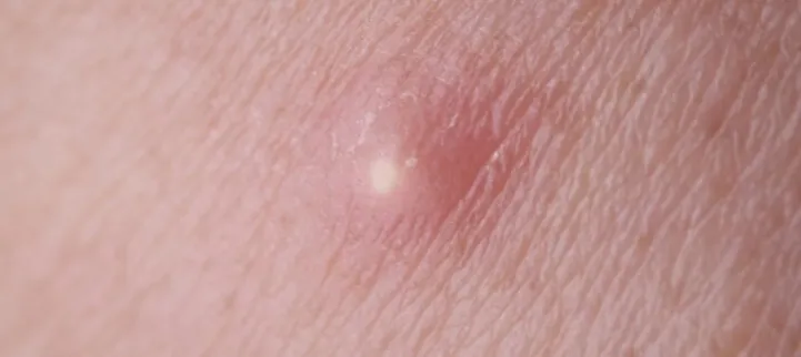 Skuteczne metody leczenia pryszcza na wardze sromowej i objawy