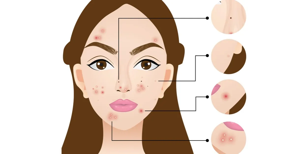 Czy warto wyciskać pryszcze? Poznaj ryzyka i lepsze metody pielęgnacji