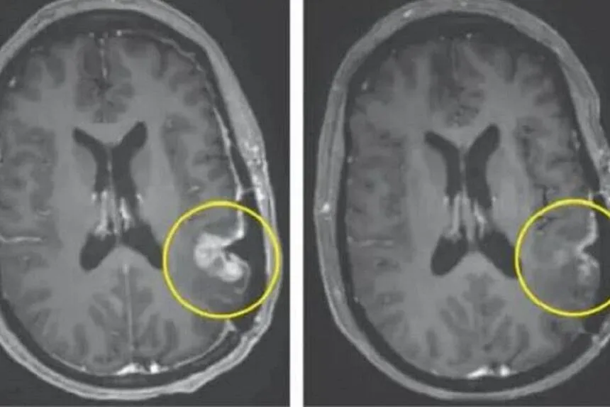 Jak odróżnić nerwicę od guza mózgu i uniknąć błędnej diagnozy