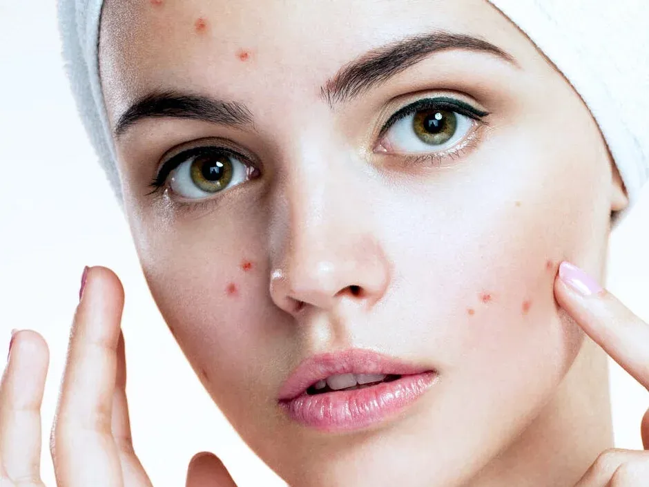 Jakiej witaminy brakuje gdy wyskakują pryszcze i jak to zmienić