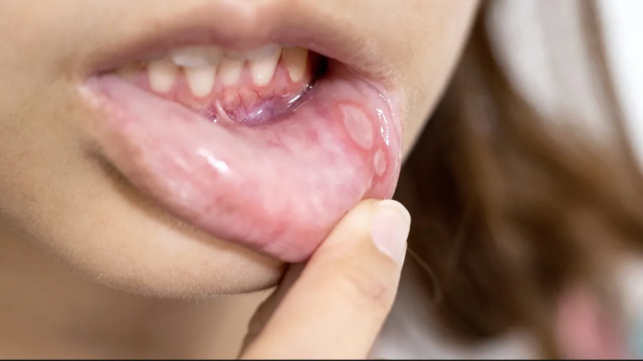 Afty na dziąśle: przyczyny, objawy i skuteczne sposoby zapobiegania