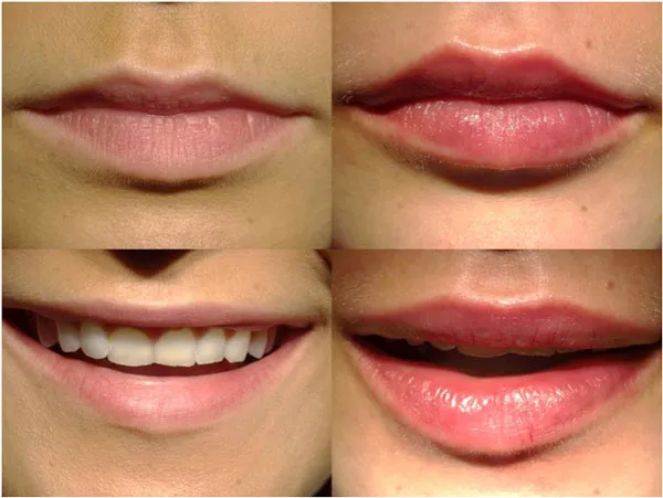 Kwas hialuronowy w ustach – jak długo utrzymuje się efekt?