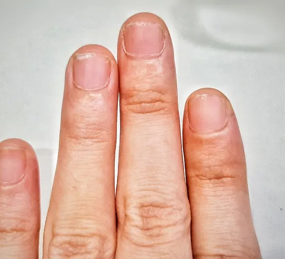 Czarne kreski pod paznokciami jak drzazgi – co mogą oznaczać?