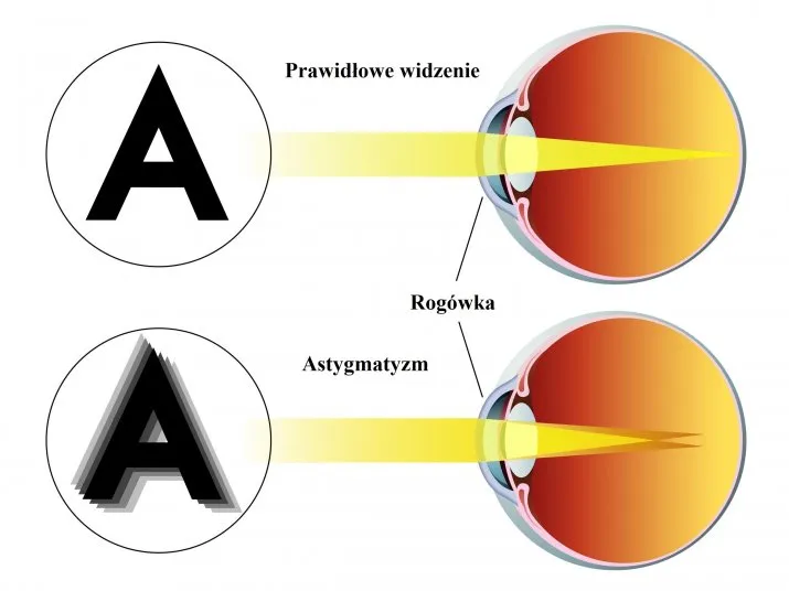 Astygmatyzm: Jak skutecznie korygować i trwale usunąć wadę?