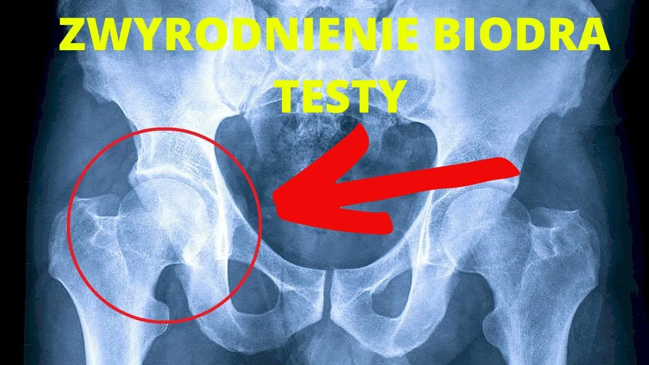 Odkryj tajniki Totalna Biologia Biodro i zwalczyj ból biodra efektywnie