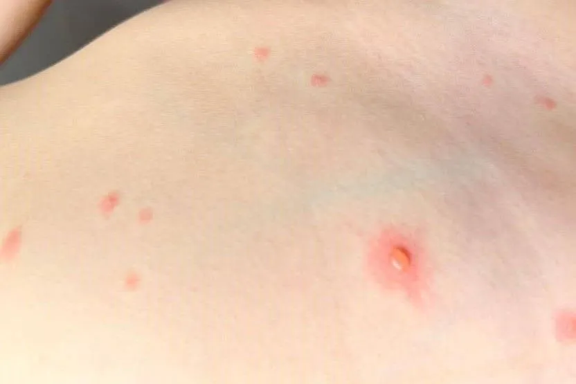 Ospa wietrzna: Skuteczne leki, pielęgnacja i czego unikać?