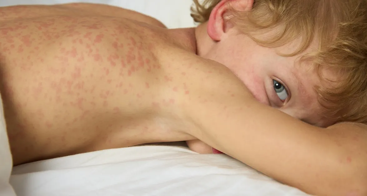 Skutki uboczne Vines: co musisz wiedzieć o działaniach niepożądanych