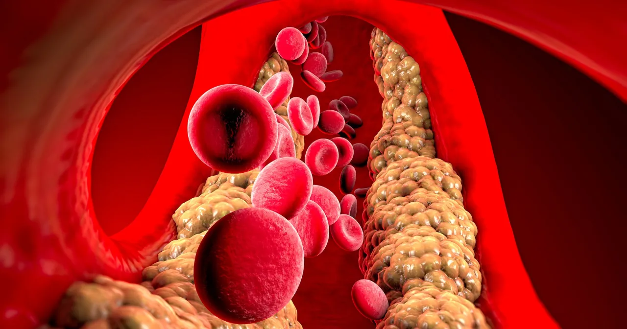 Wysoki cholesterol: Cichy zabójca? Poznaj przyczyny i skuteczne metody