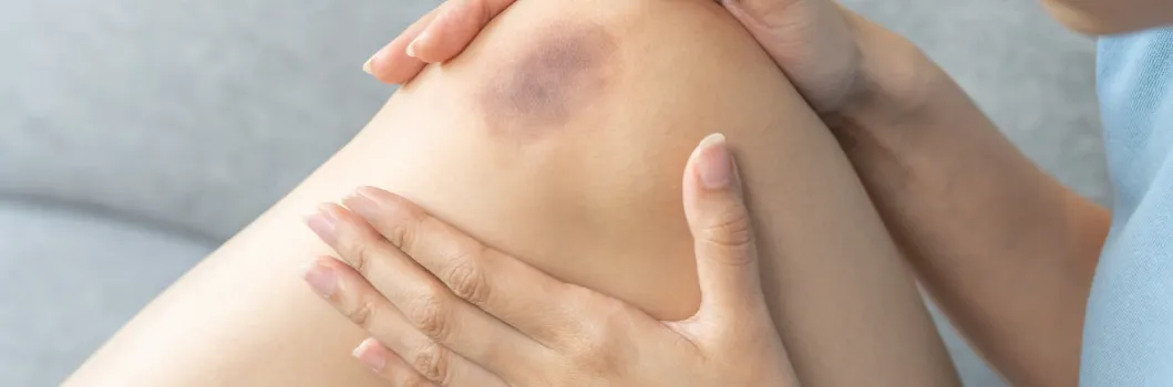 Ile trzyma opuchlizna po skręceniu? Fakty, które musisz znać