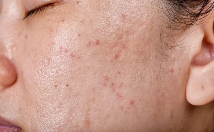 Jak skutecznie walczyć z tłustą cerą i poprawić wygląd skóry