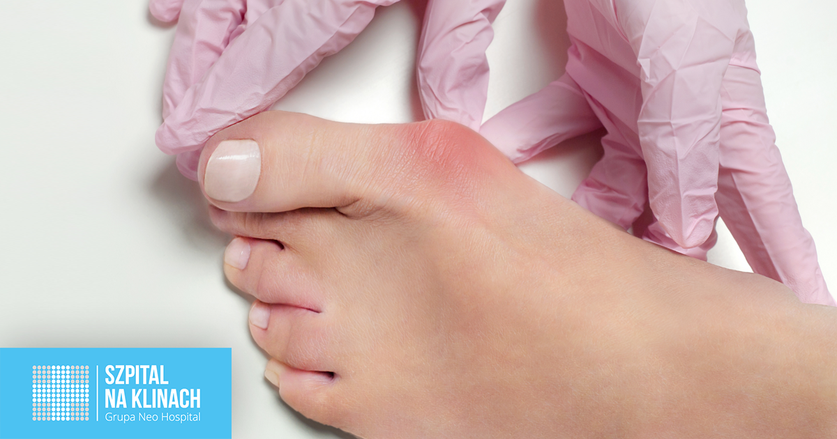 Haluksy: Kto leczy i jak wygląda droga do zdrowych stóp?