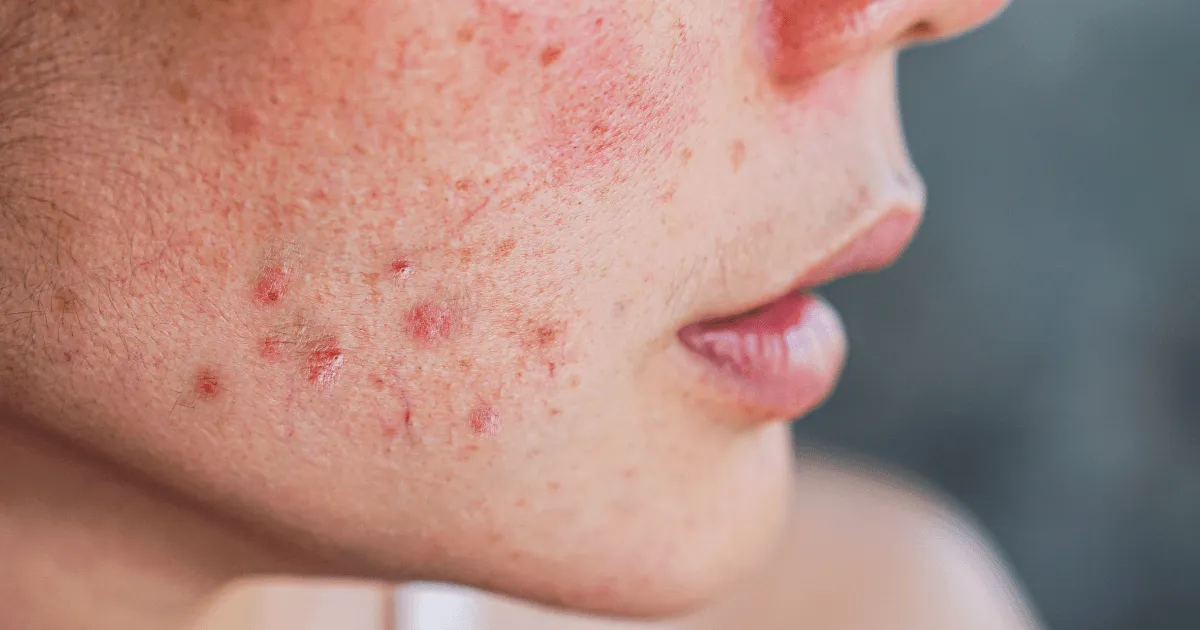 Cera trądzikowa co stosować, aby skutecznie zwalczyć trądzik