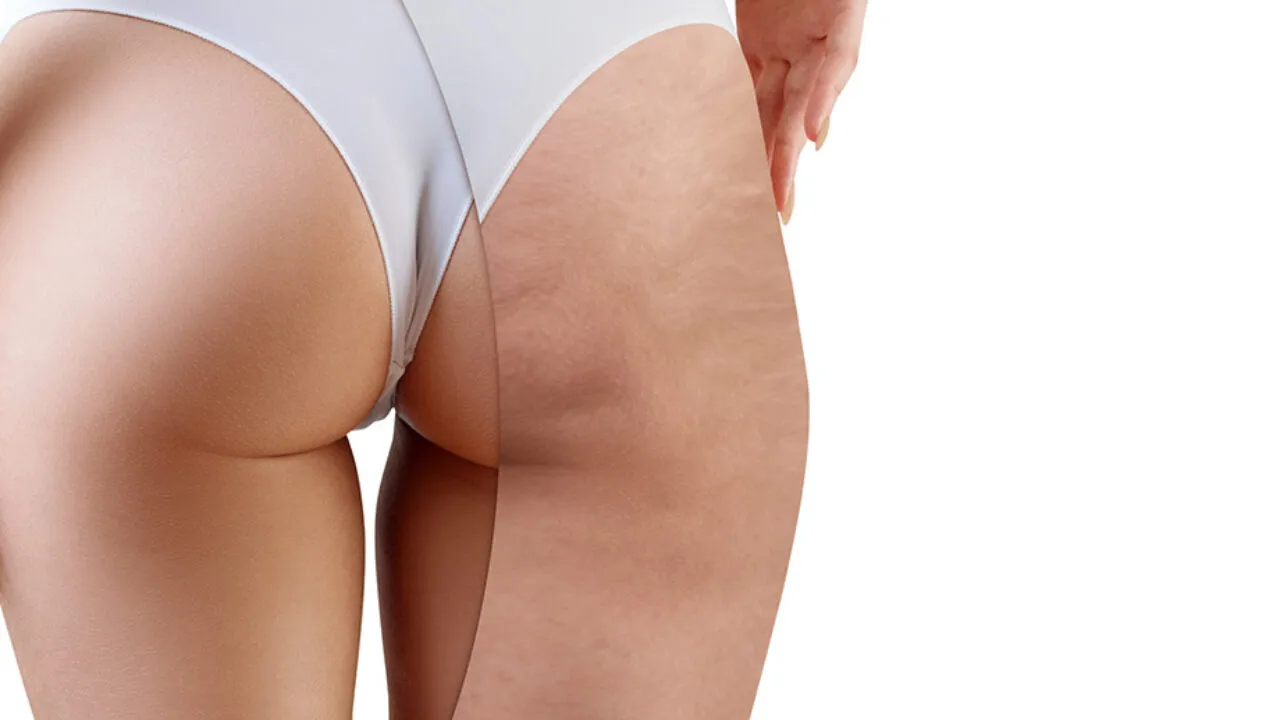 Motywujące cytaty o cellulicie: Inspiracja do walki ze skórką