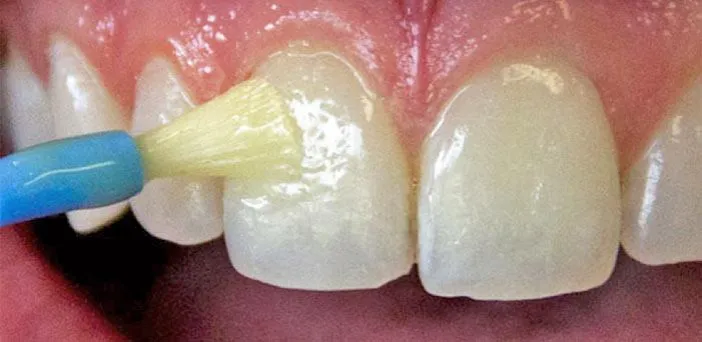 Czy fluoryzacja wybiela zęby? Odkryj prawdę o jej działaniu