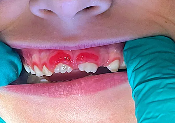 Jak długo trwa zapalenie jamy ustnej u dziecka i co wpływa na czas leczenia