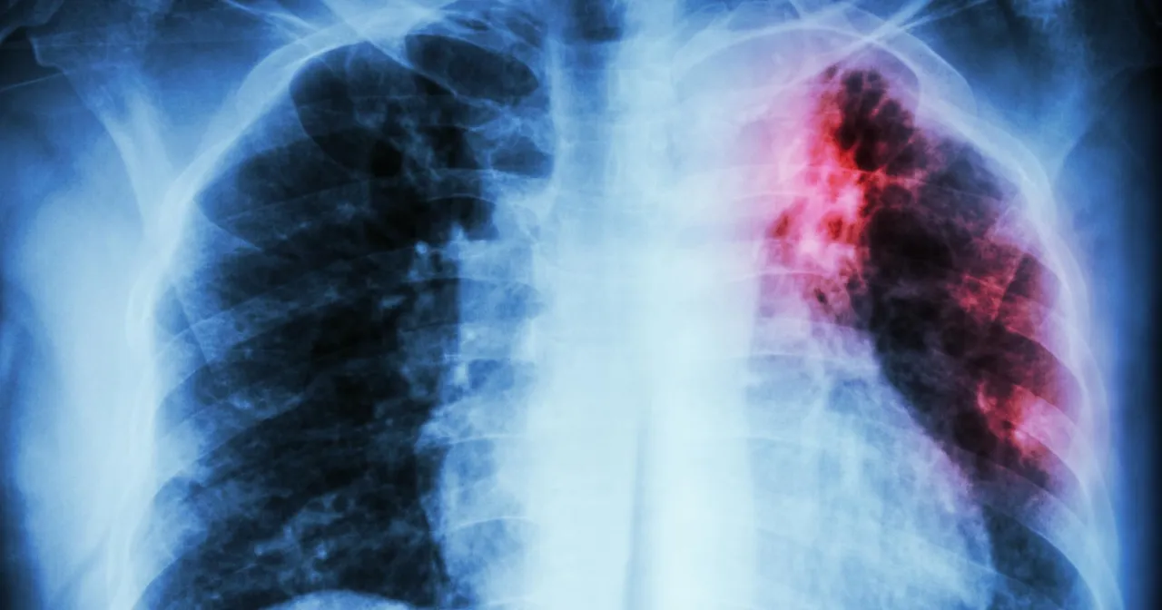 Gruźlica (TBC): objawy, leczenie, profilaktyka w Polsce