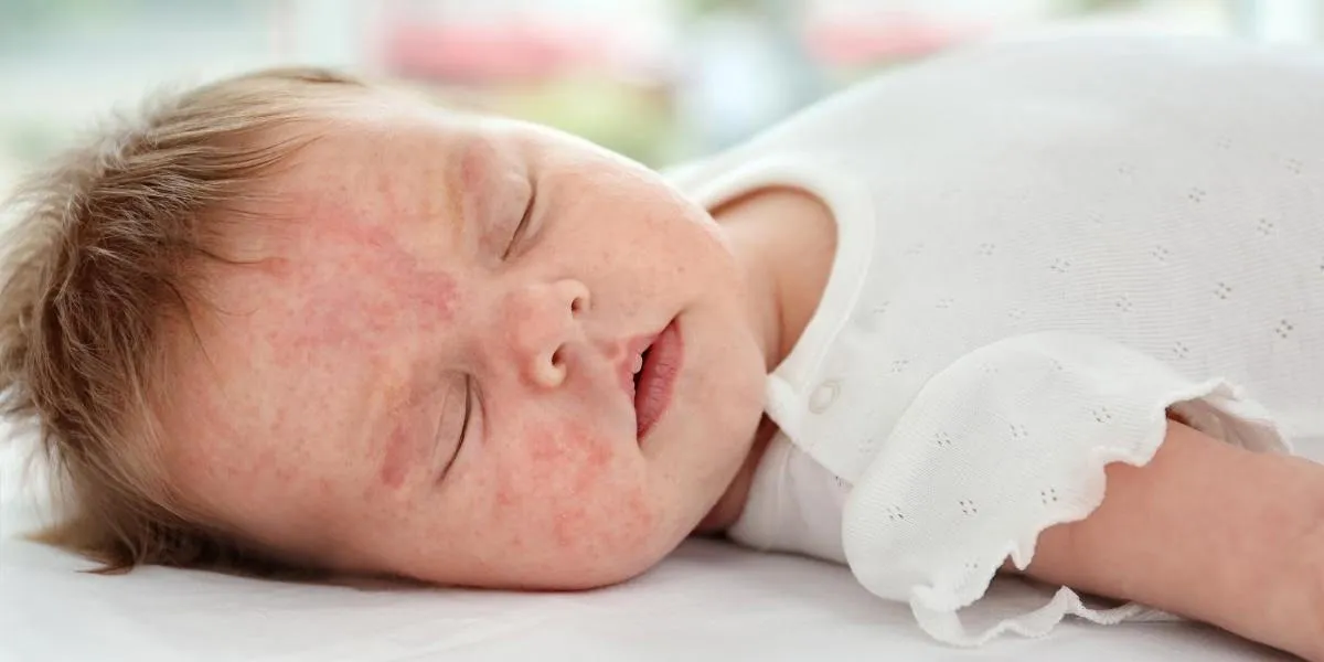 Alergia u niemowlaka objawy – jak je rozpoznać i co zrobić?