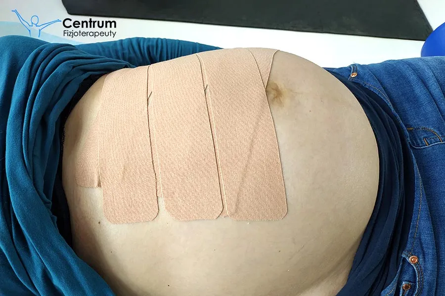 Jakie ćwiczenia przy przepuklinie pępkowej pomogą uniknąć bólu?