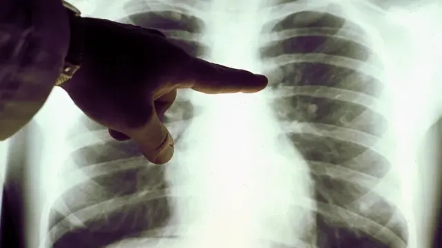 Quién descubrió el linfoma no Hodgkin y su historia sorprendente