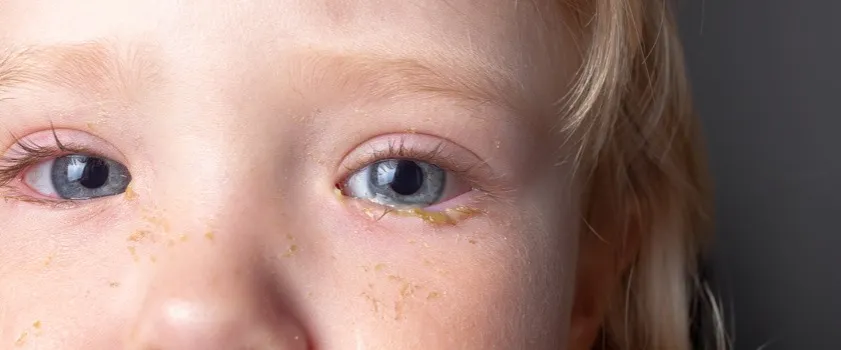 Dlaczego dziecku ropieją oczy? Poznaj przyczyny i objawy