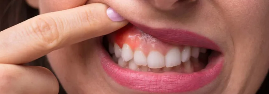Co na spuchnięte dziąsło – skuteczne sposoby na ból i obrzęk