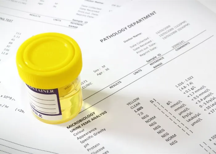 Czy w badaniu moczu wyjdzie nikotyna? Oto co musisz wiedzieć