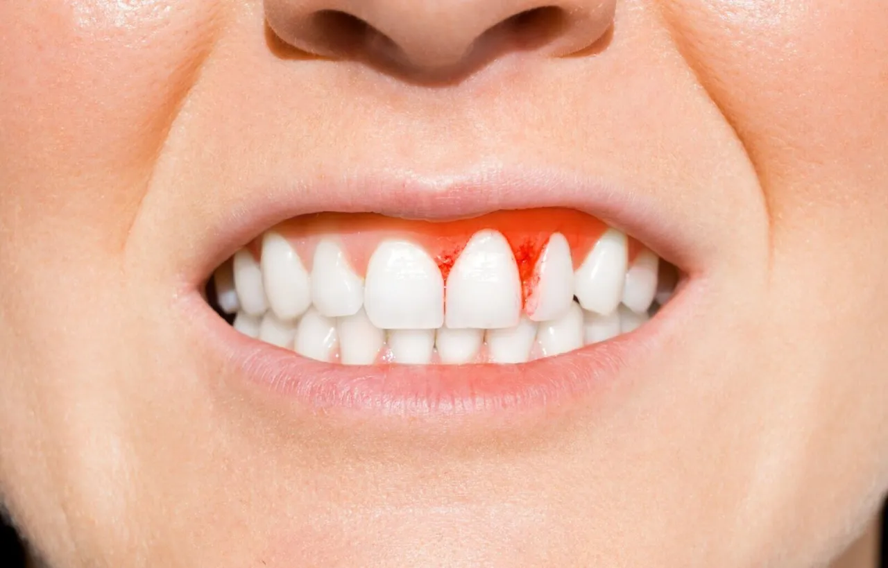 Jak zatamować krwotok po wyrwaniu zęba i uniknąć powikłań