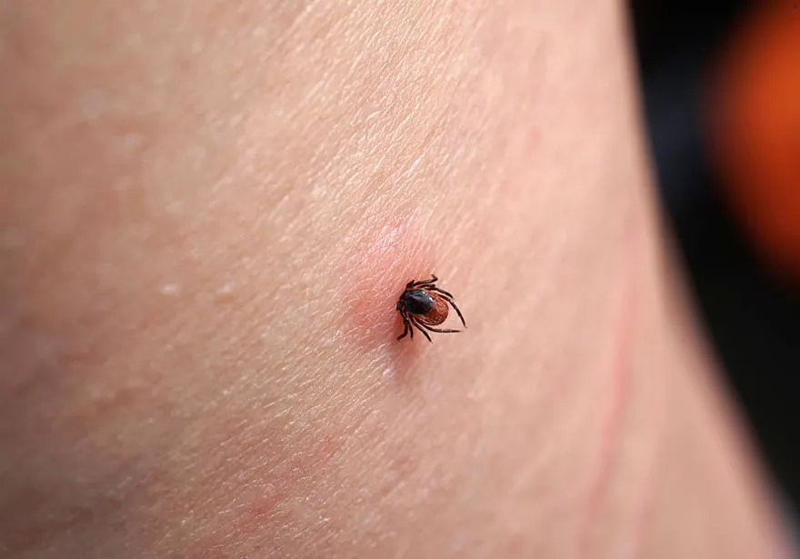 Co zrobić, gdy w skórze zostanie głowa kleszcza - ważne kroki i ryzyko