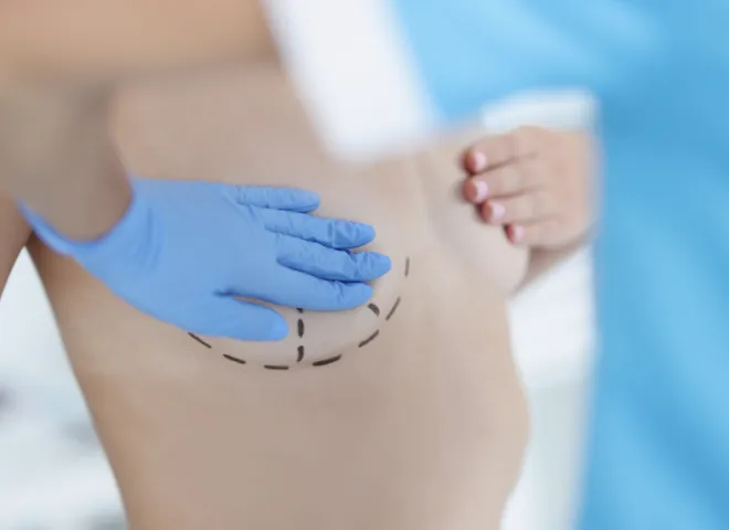 Ile kosztuje powiększenie biustu tłuszczem? Zaskakujące ceny w Polsce