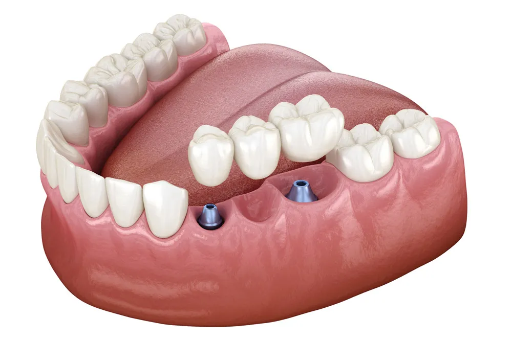 Ile kosztuje most na 1 ząb? Sprawdź ceny i co wpływa na koszt