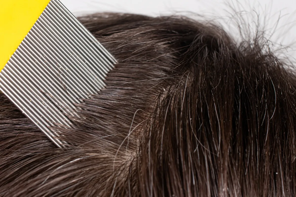 Wszy u dziecka co robić: skuteczne metody leczenia i zapobiegania