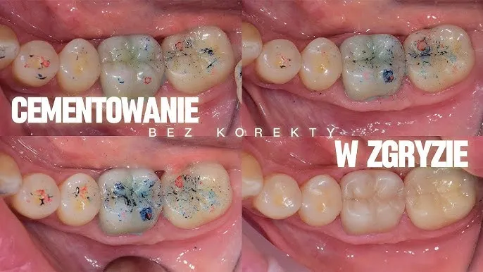Jak stosować cement NoMIX, aby uniknąć nieprzyjemnych sytuacji z koronami dentystycznymi
