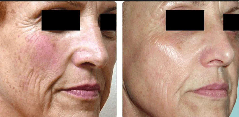 Laser frakcyjny co to jest i jakie przynosi korzyści dla skóry