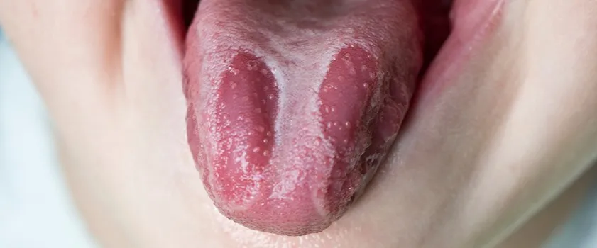 Infekcja jamy ustnej objawy – jak je rozpoznać i leczyć skutecznie