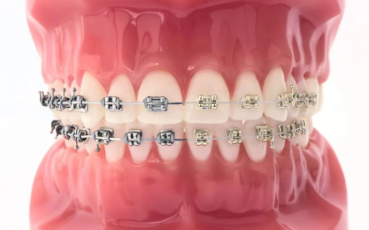 Czy aparat na zęby boli? Jak uniknąć bólu i dyskomfortu podczas noszenia