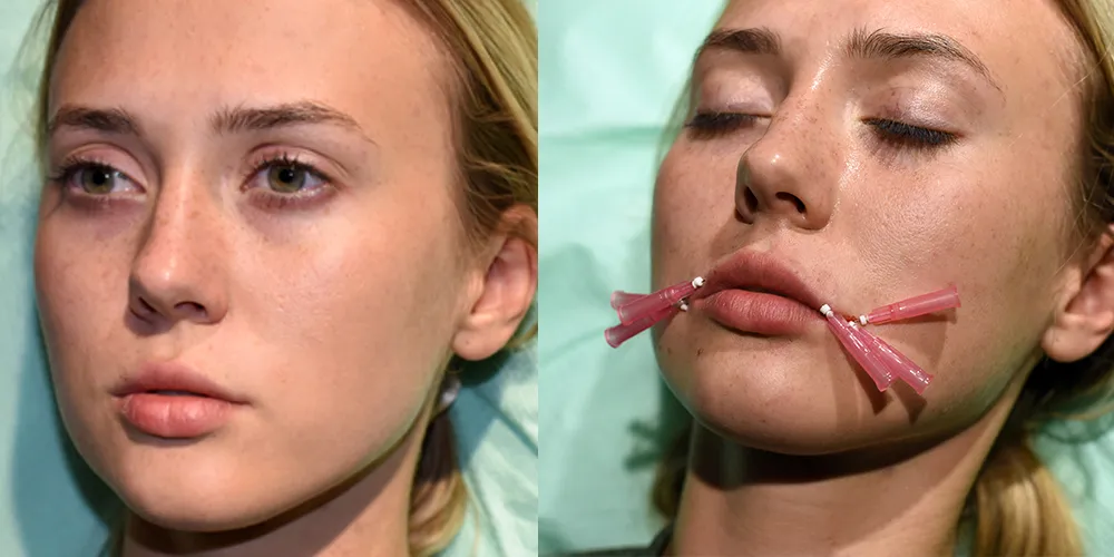 Co lepsze: nici PDO czy kwas hialuronowy - porównanie efektów i ryzyk