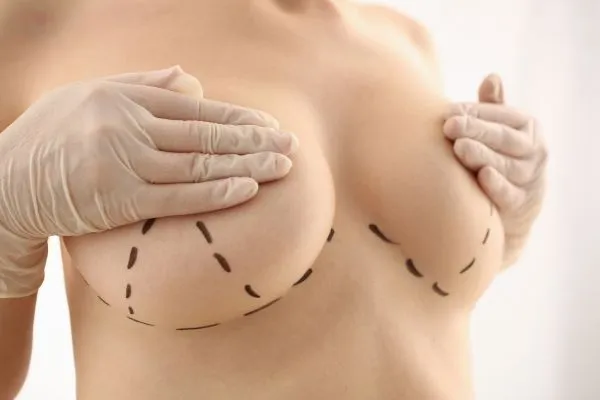 Ile kosztuje lifting biustu? Ceny, czynniki wpływające na koszt i więcej.