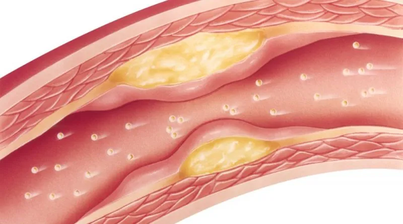 Jakie badania na miażdżycę? Kluczowe testy dla zdrowia naczyń