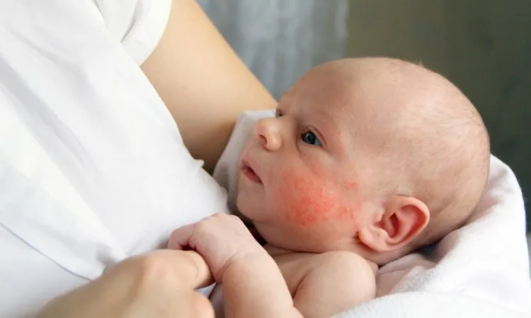 Rumień zakaźny kiedy do przedszkola - ważne informacje dla rodziców