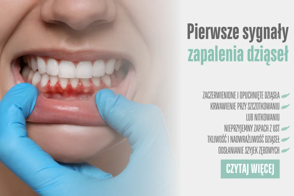 Zapalenie dziąseł: Skuteczne domowe i apteczne sposoby na ulgę