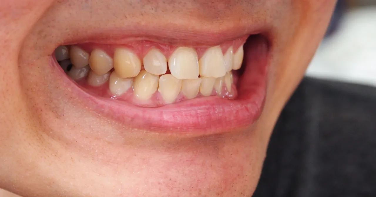 Jak skutecznie pozbyć się żółtych zębów – domowe i profesjonalne metody