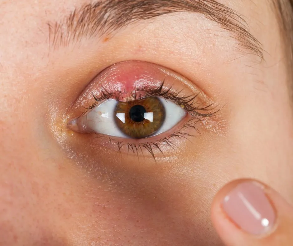 Czy dziecko z jęczmieniem może iść do przedszkola? Sprawdź, jak zadbać o zdrowie.