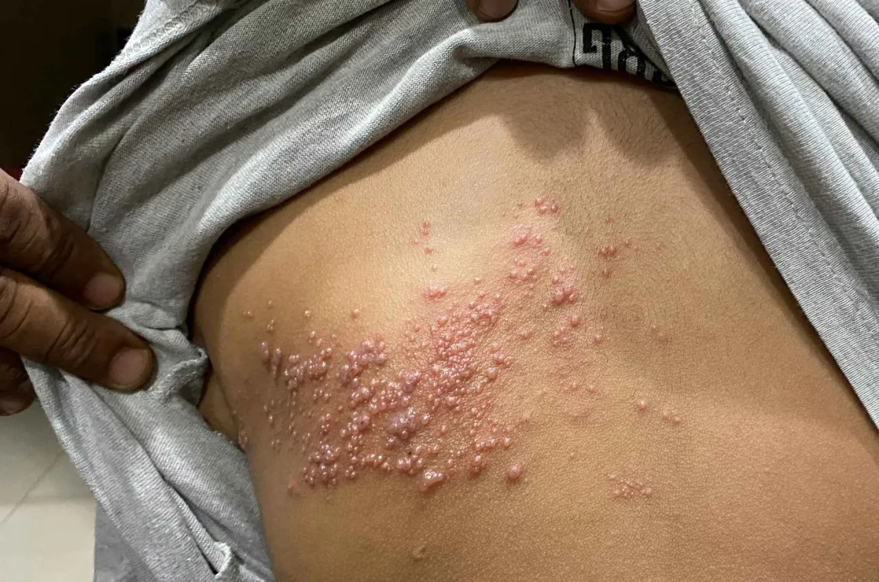 Jak długo leczyć półpasiec? Klucz do uniknięcia bólu i powikłań