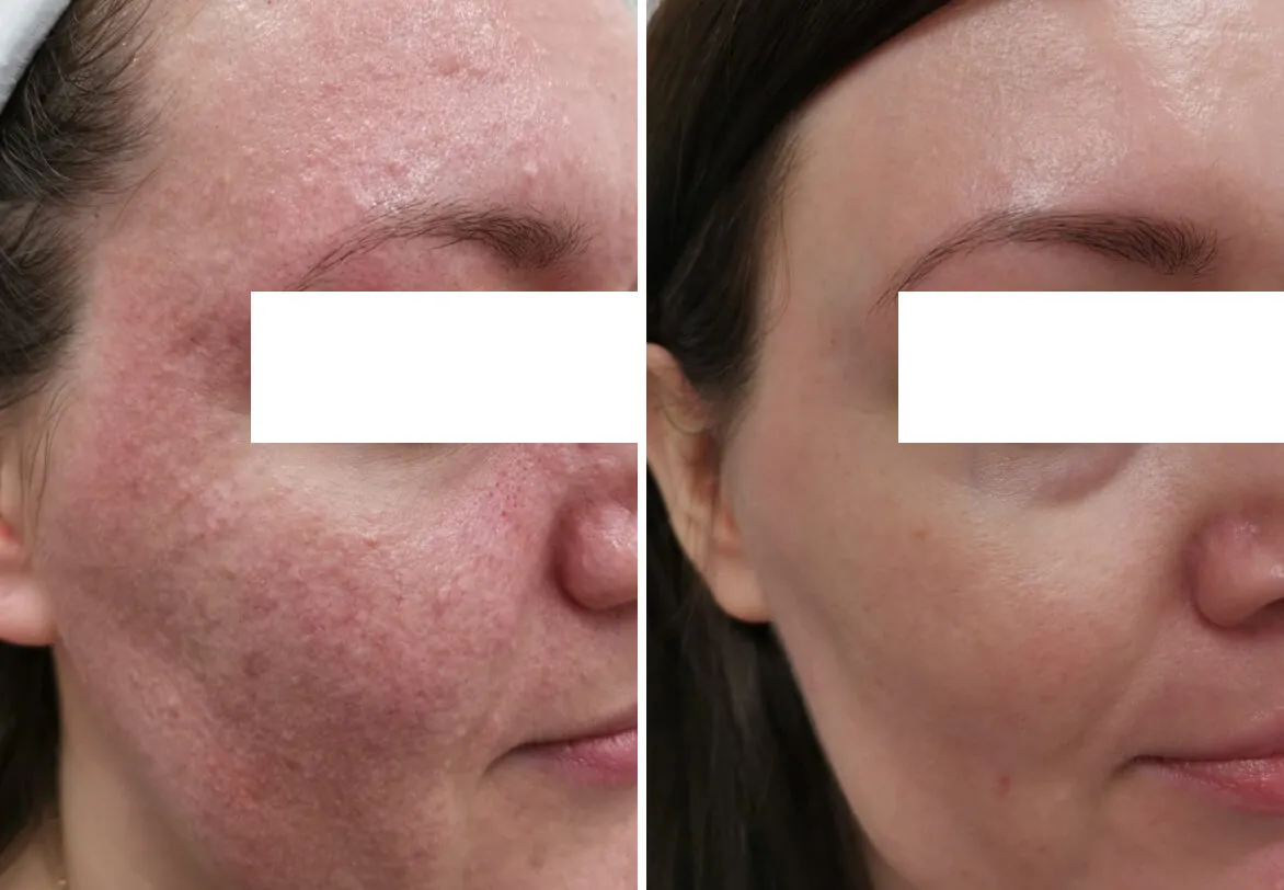 Ile trwa zabieg laserem frakcyjnym i co musisz wiedzieć przedtem