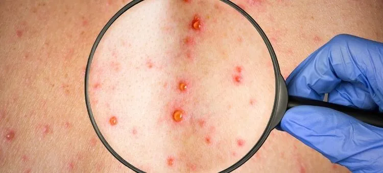 Jak zapobiec ospie po kontakcie z chorym i uniknąć zakażenia