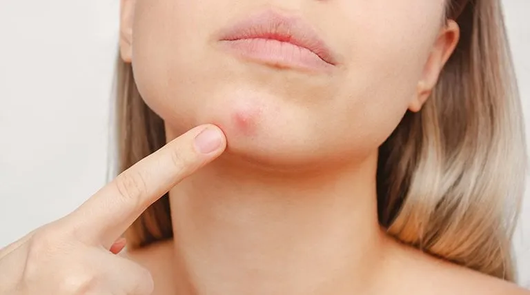 Dlaczego pryszcze strzelają i jak uniknąć poważnych problemów