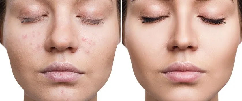 Skuteczne usuwanie śladów po pryszczach: Domowe i profesjonalne metody